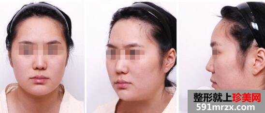 打一次保妥适botox瘦脸针前后对比效果图真实案例分享