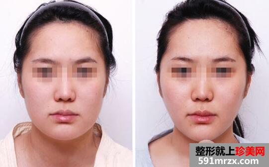 打一次保妥适botox瘦脸针前后对比效果图真实案例分享