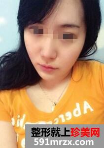 打一次保妥适botox瘦脸针前后对比效果图真实案例分享