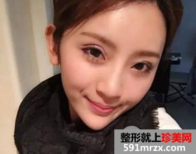 全脸自体脂肪面部填充真实案例和恢复过程前后对比图