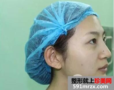 全脸自体脂肪面部填充真实案例和恢复过程前后对比图
