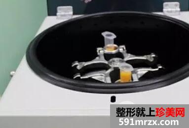 全脸自体脂肪面部填充真实案例和恢复过程前后对比图