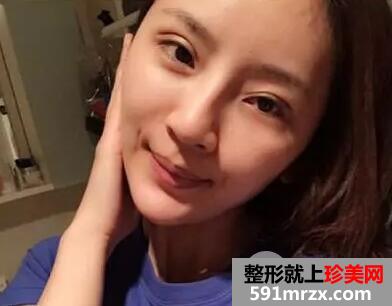 全脸自体脂肪面部填充真实案例和恢复过程前后对比图