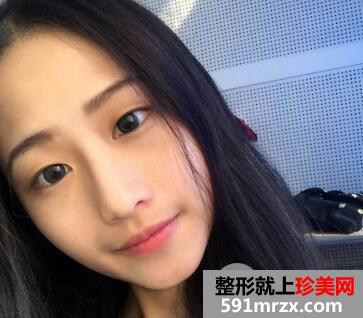 割双眼皮要花多少钱？真人案例一个月恢复图
