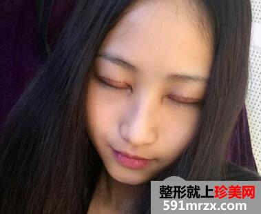 割双眼皮要花多少钱？真人案例一个月恢复图