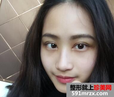 割双眼皮要花多少钱？真人案例一个月恢复图