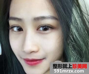 割双眼皮要花多少钱？真人案例一个月恢复图
