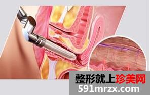 女性私密整形需要多少钱？安全吗？私密整形恢复过程案例