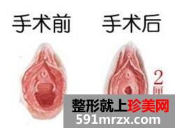 女性私密整形需要多少钱？安全吗？私密整形恢复过程案例