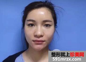 一次性做了割双眼皮+隆鼻恢复过程图日记
