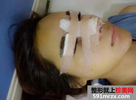 一次性做了割双眼皮+隆鼻恢复过程图日记