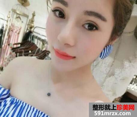 一次性做了割双眼皮+隆鼻恢复过程图日记
