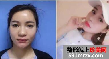 一次性做了割双眼皮+隆鼻恢复过程图日记