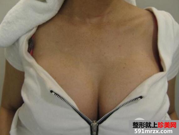 毛面麦格假体隆胸多少钱？恢复过程真实案例图片分享