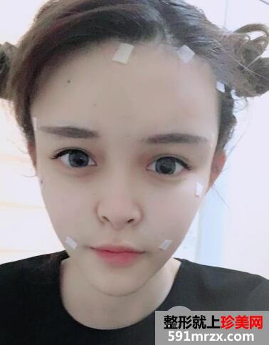 抽大腿脂肪做的全脸脂肪填充价格1.2w恢复3个月效果分享