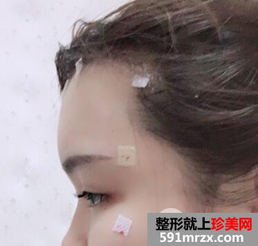 抽大腿脂肪做的全脸脂肪填充价格1.2w恢复3个月效果分享