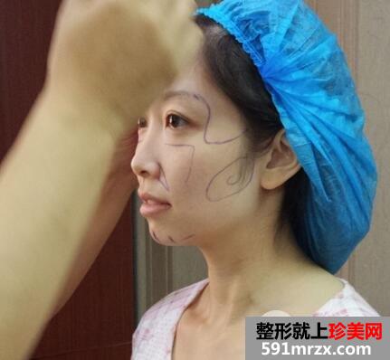 脸部脂肪填充多少钱？脸部脂肪填充消肿恢复过程真实案例