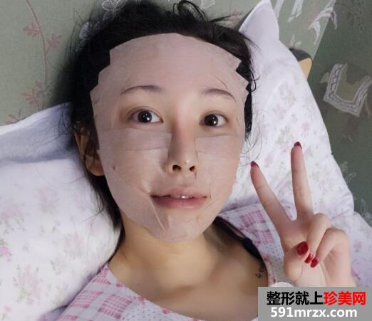 脸部脂肪填充多少钱？脸部脂肪填充消肿恢复过程真实案例