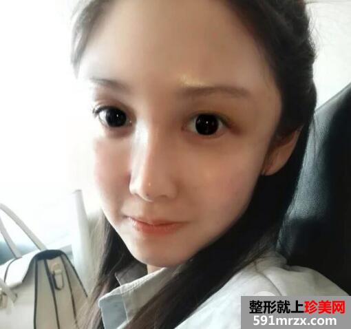 脸部脂肪填充多少钱？脸部脂肪填充消肿恢复过程真实案例