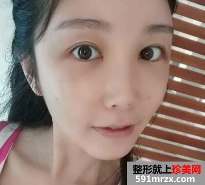 脸部脂肪填充多少钱？脸部脂肪填充消肿恢复过程真实案例