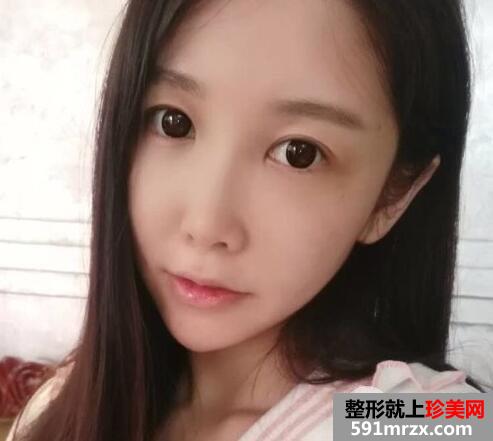 脸部脂肪填充多少钱？脸部脂肪填充消肿恢复过程真实案例