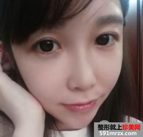 脸部脂肪填充多少钱？脸部脂肪填充消肿恢复过程真实案例