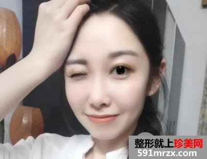 脸部脂肪填充多少钱？脸部脂肪填充消肿恢复过程真实案例
