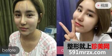 自体脂肪面部填充多钱？ 太阳穴泪沟额头填充对比图
