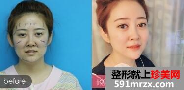自体脂肪面部填充多钱？ 太阳穴泪沟额头填充对比图