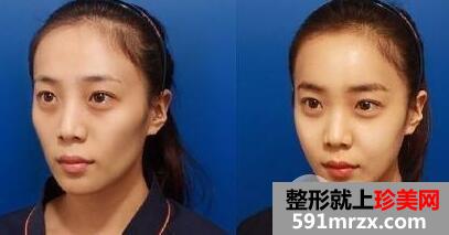 自体脂肪面部填充多钱？ 太阳穴泪沟额头填充对比图