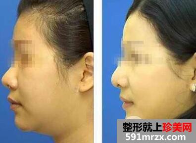 面部吸脂大概要多少钱？面部吸脂减肥价格表和前后效果图片