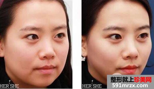 面部吸脂大概要多少钱？面部吸脂减肥价格表和前后效果图片