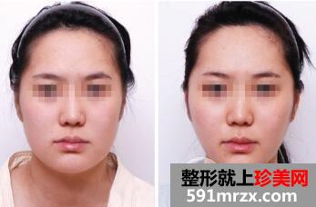 面部吸脂大概要多少钱？面部吸脂减肥价格表和前后效果图片