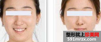 面部吸脂大概要多少钱？面部吸脂减肥价格表和前后效果图片