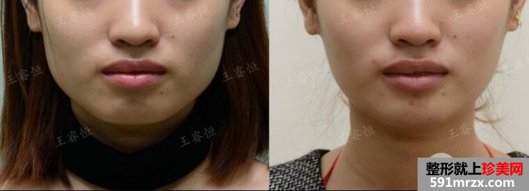 瘦脸针价格多少钱?能持续多久?打几次能定型?【详介】