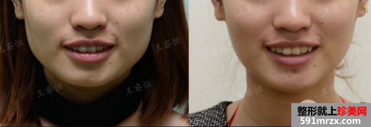 瘦脸针价格多少钱?能持续多久?打几次能定型?【详介】
