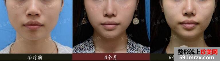 瘦脸针价格多少钱?能持续多久?打几次能定型?【详介】