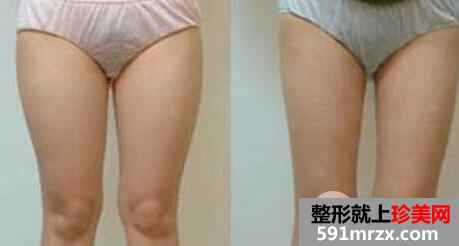 最有效的懒人减肥法是吸脂减肥【价格】