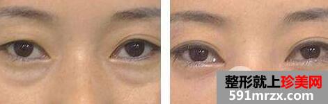 不开刀去眼袋手术价位和手术方法介绍