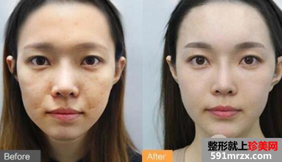 水光针多少钱一针？效果好吗？