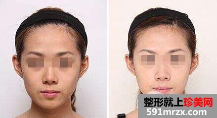 水光针多少钱一针？效果好吗？
