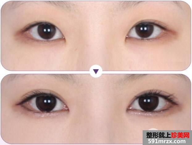 合肥华美双眼皮价格表