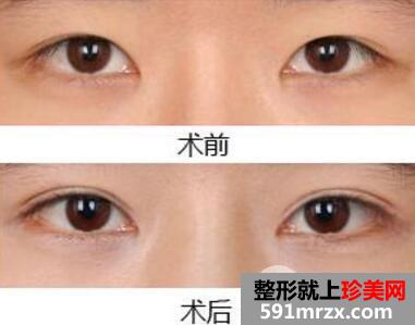 郑大一附院整形双眼皮价格表