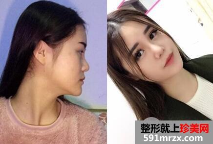 隆鼻手术及隆鼻价格表介绍