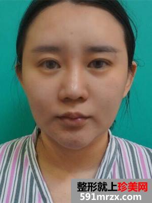 瘦脸吸脂术真实案例分享和前后照片对比