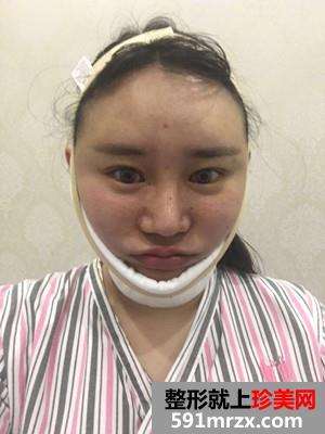 瘦脸吸脂术真实案例分享和前后照片对比