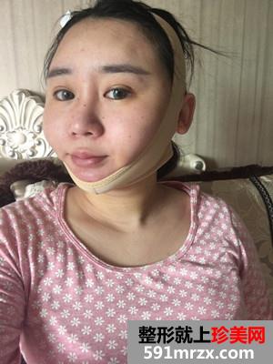 瘦脸吸脂术真实案例分享和前后照片对比