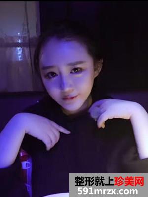 瘦脸吸脂术真实案例分享和前后照片对比
