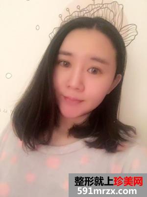 瘦脸吸脂术真实案例分享和前后照片对比