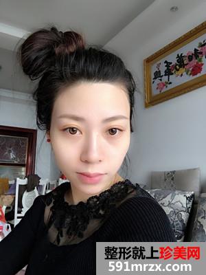 自体脂肪移植垫下巴术恢复过程分享和前后对比照